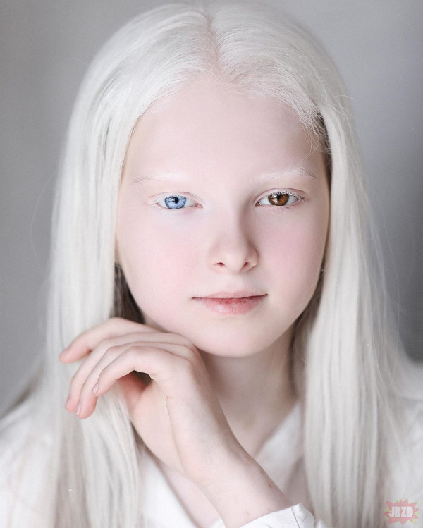 Heterohromia i albinizm w jednym