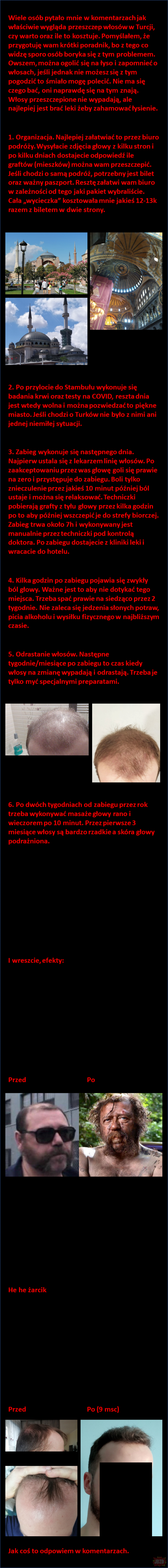 Przeszczep włosów w Turcji - poradnik