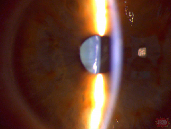 Optometry life  no.1 - zaćma korowa