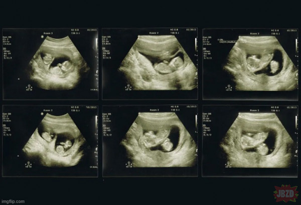 Fetus in fetu i VTS – Kiedy jedno z bliźniąt wchłania drugie